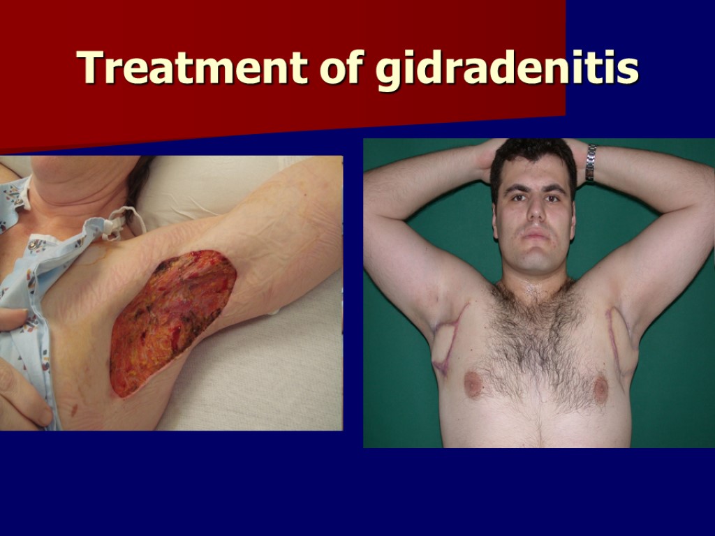 Treatment of gidradenitis